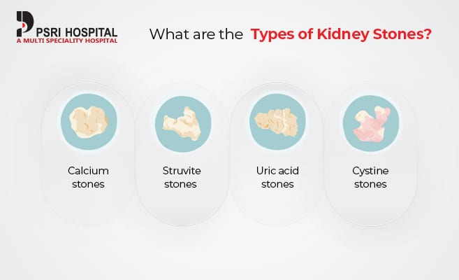what are the types of kidney stones