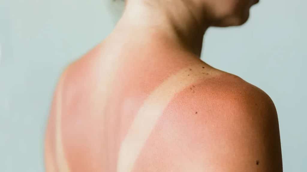 sunburn and skin protection