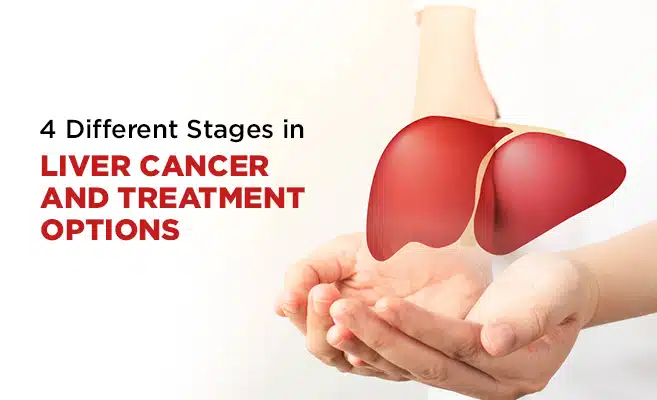  4 Different Stages in Liver Cancer and Treatment Options 
