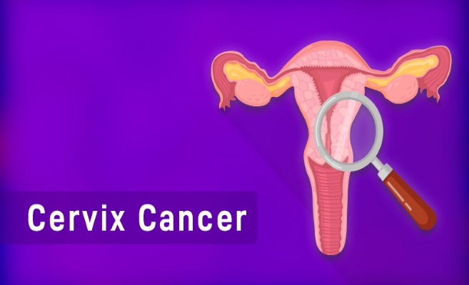  Cervix Cancer 