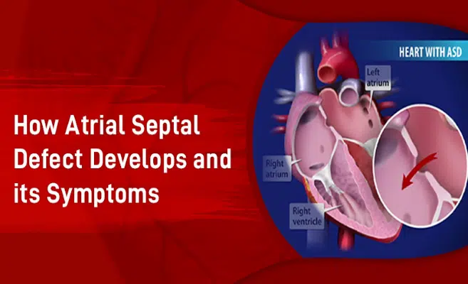 How Atrial Septal Defect Develops and its Symptoms