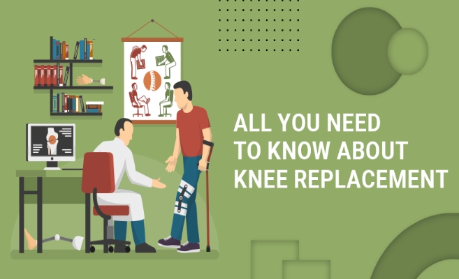  All You Need To Know About Knee Replacement 