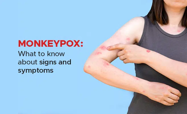 What is monkeypox and its signs and symptoms?