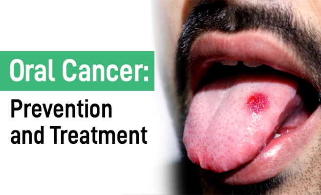 Oral Cancer: Prevention and Treatment