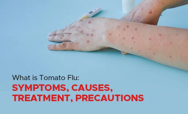  Tomato Flu: Symptoms, Causes, Treatment, Precautions 