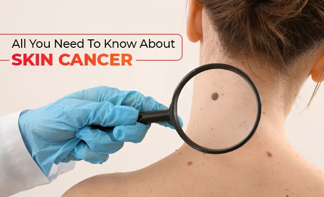  All You Need To Know About Skin Cancer 
