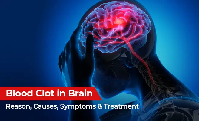 Blood Clot in Brain: Reason, Causes, Symptoms & Treatment