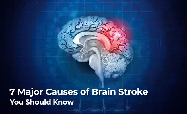  Top 7 Causes of a Brain Stroke – Major Risk Factors and Prevention 