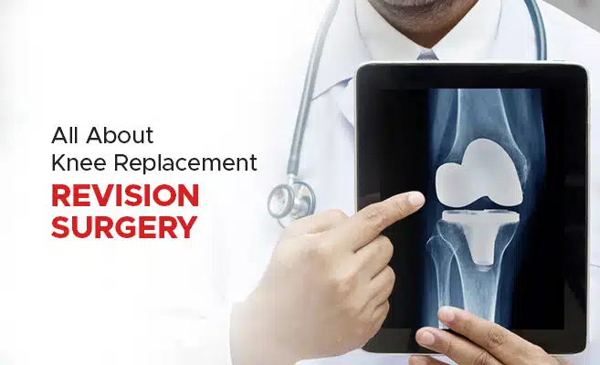 All About Knee Replacement Revision Surgery