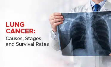  Lung Cancer: Causes, Stages and Survival Rates 