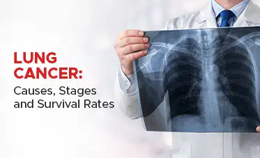 Lung Cancer: Causes, Stages and Survival Rates