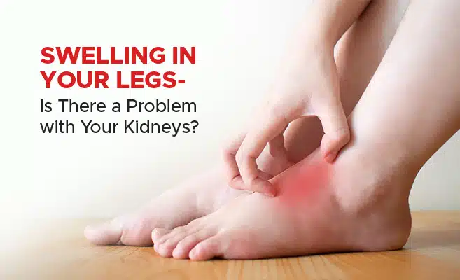 Edema: Why Your Feet Are Puffy