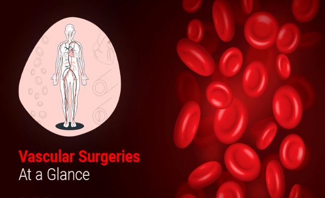 Vascular Surgeries At A Glance