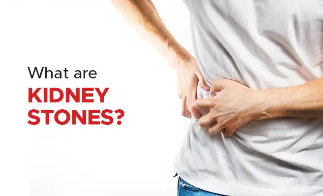  What are Kidney Stones? 