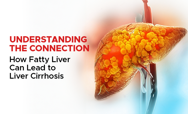  Understanding the Connection: How Fatty Liver Can Lead to Liver Cirrhosis 