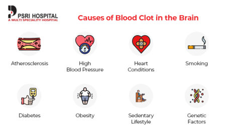 Blood Clot in Brain: Causes, Symptoms & Treatment