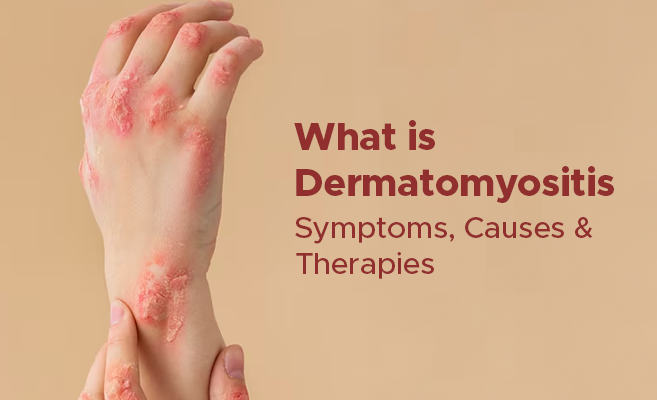  What is Dermatomyositis: Symptoms, Causes & Therapies 