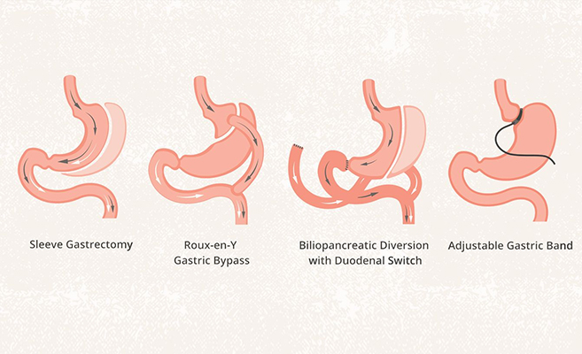 benefits of bariatric surgery