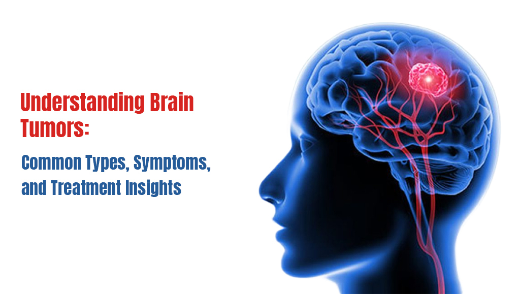 Understanding Brain Tumors: Common Types, Symptoms, and Treatment Insights