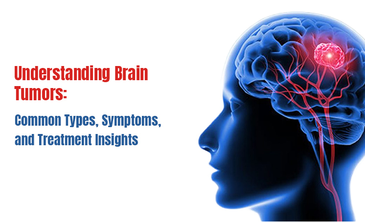  Understanding Brain Tumors: Common Types, Symptoms, and Treatment Insights 
