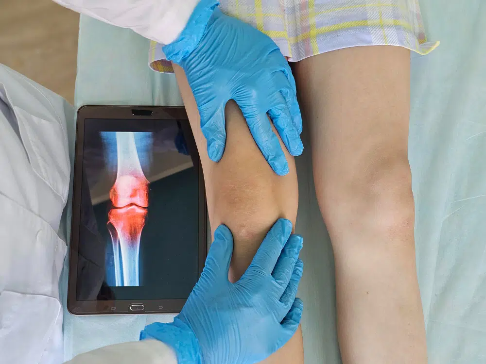 What Is Robotic Knee Replacement